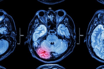 Brain Scan of a Personal Injury Victim with Head Trauma