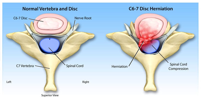Image of disc herniation after automobile accident